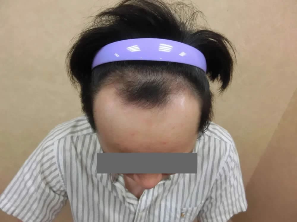 FUE 1800 株額前髮際線案例:植髮前