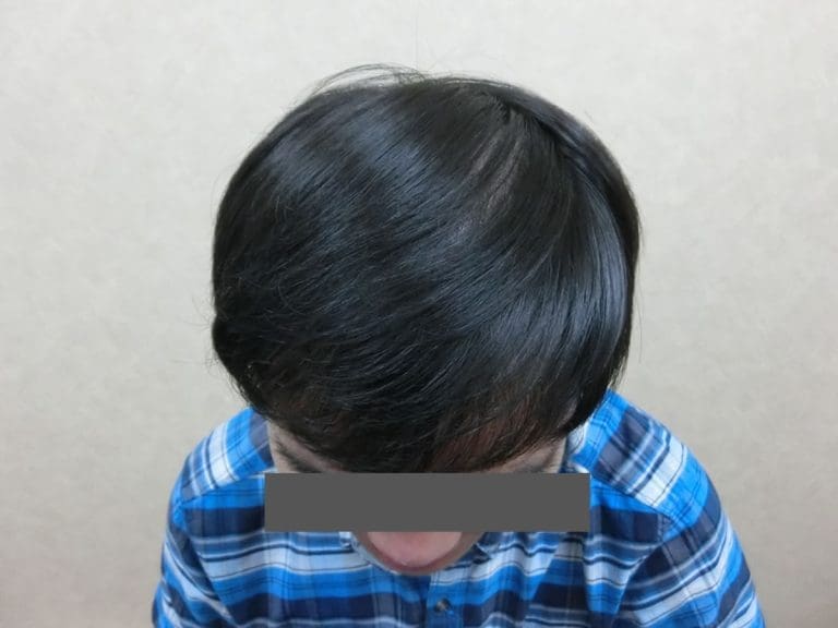 陳先生的3945株 COMBO 巨量植髮心得分享｜FUE+FUT 雙技術結合