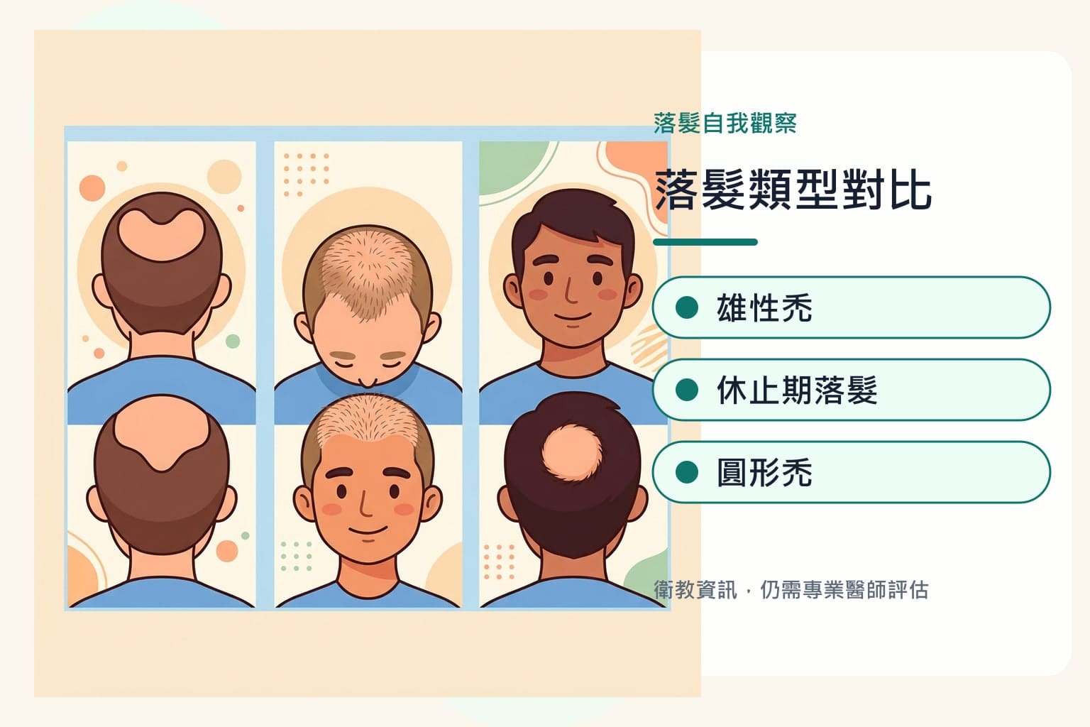 雄性禿判斷 3