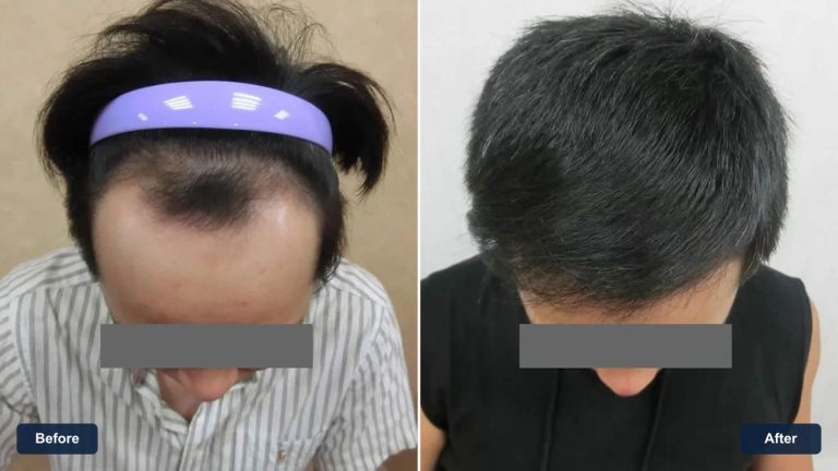 FUE 1800 株植髮案例｜額前髮際線影像紀錄