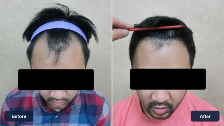 FUE 1523 株植髮案例正面髮際線療程前與約 7 個月追蹤比較，眼睛已遮蔽