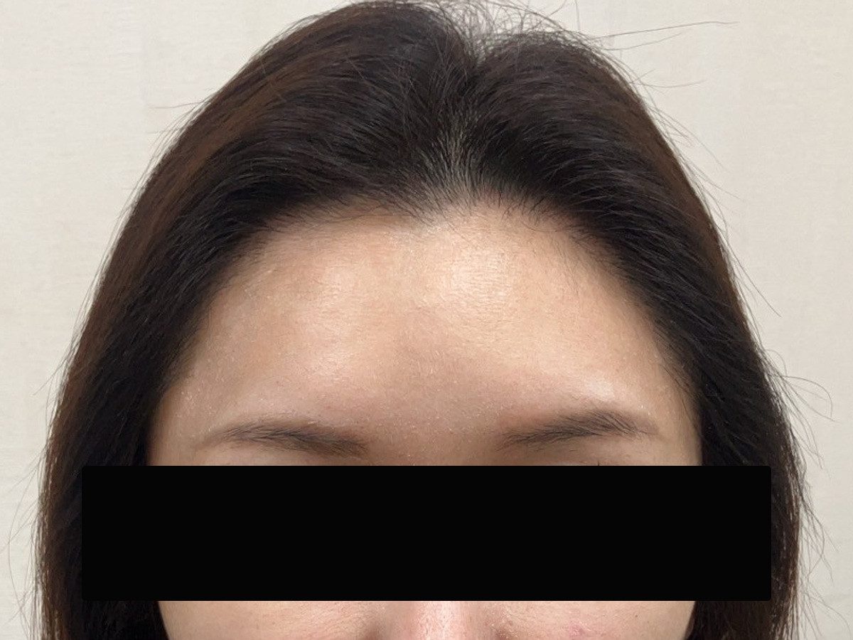 35 歲台灣女性正面髮際線療程前與後續影像:植髮後