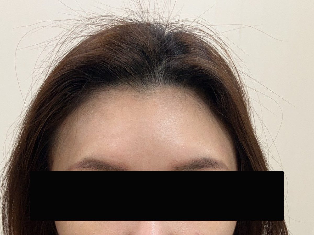 35 歲台灣女性正面髮際線療程前與後續影像:植髮前