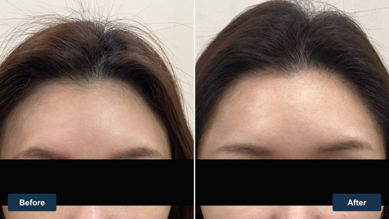 台灣 35 歲女性髮際線植髮案例｜雙角度影像紀錄
