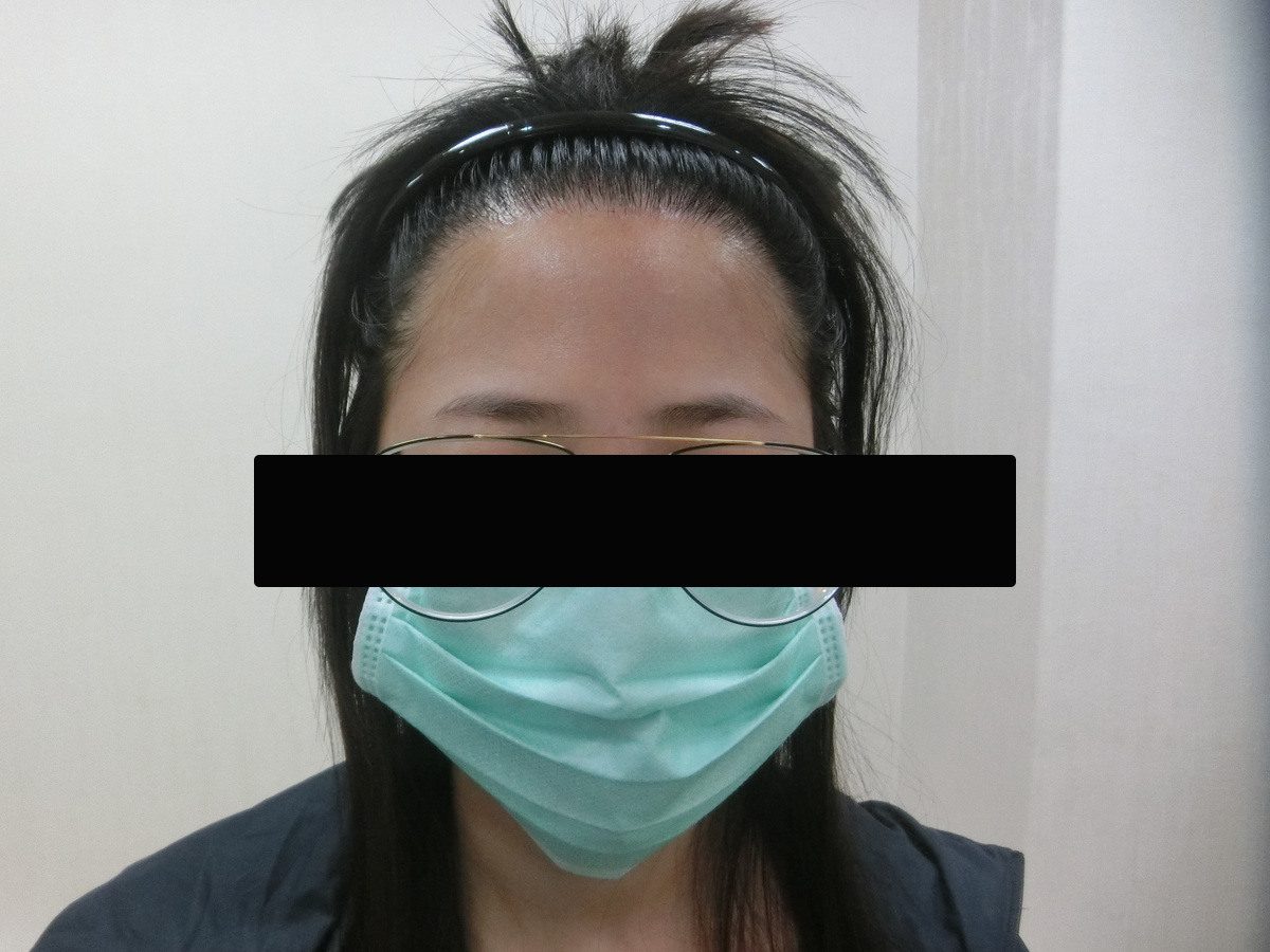 女性髮際線正面療程前與後續影像:植髮後