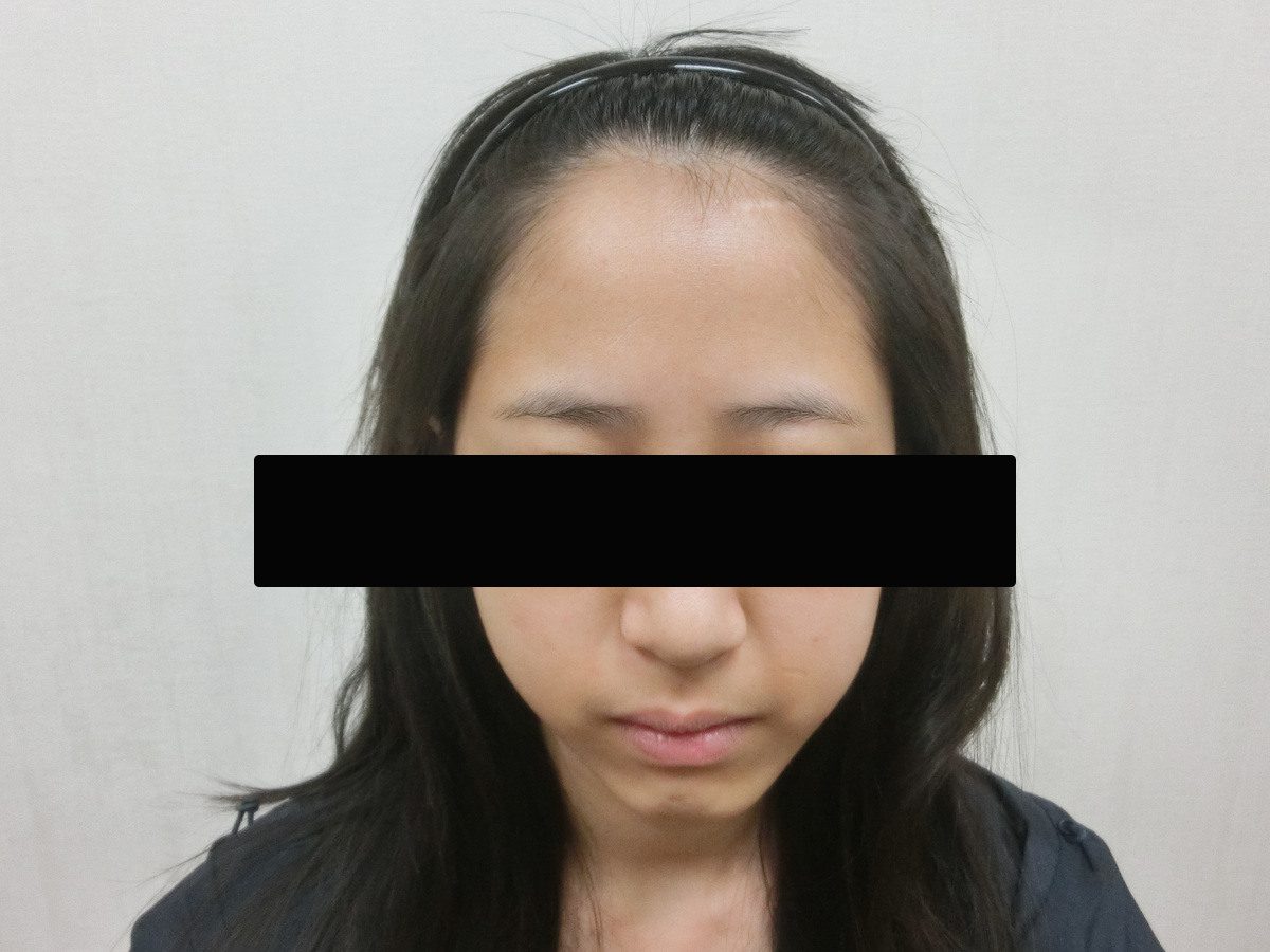 女性髮際線正面療程前與後續影像:植髮前
