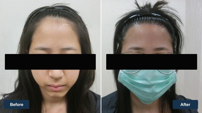 女性前額髮際線植髮案例｜正面整體輪廓紀錄