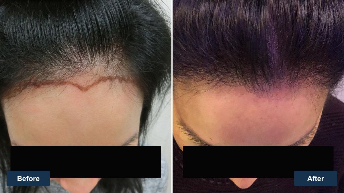 女性高額頭植髮案例俯視與右額角療程前與後續影像，眼部已遮蔽