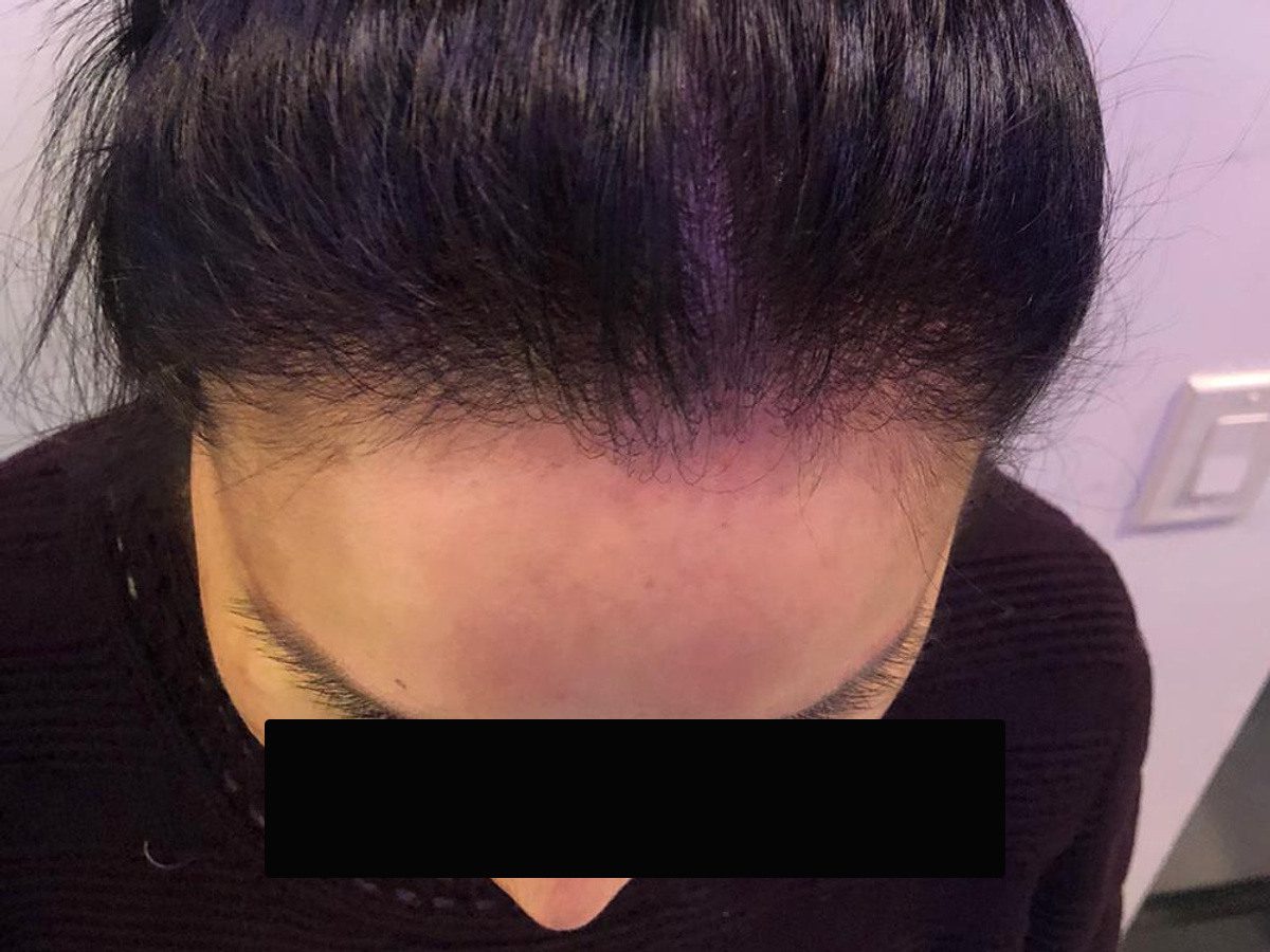 女性高髮際線前額俯視療程前與後續影像:植髮後