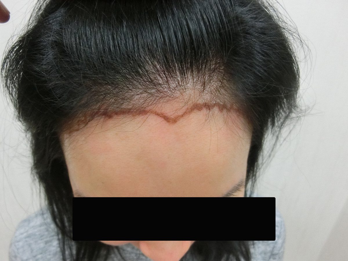 女性高髮際線前額俯視療程前與後續影像:植髮前