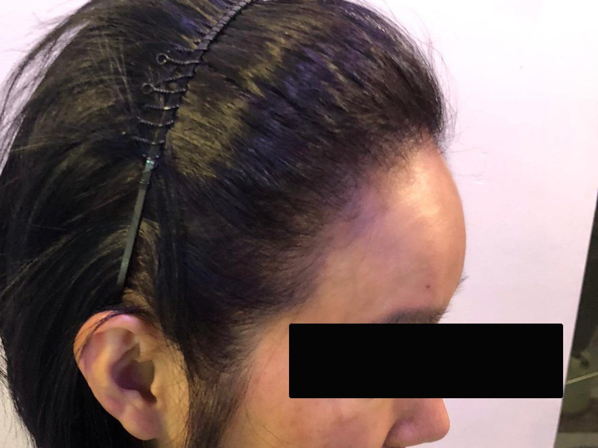 女性高髮際線右側額角療程前與後續影像:植髮後