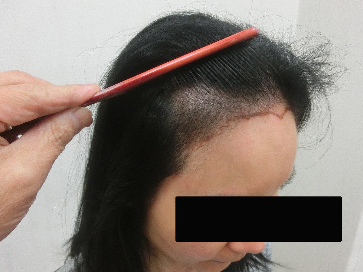 女性高髮際線右側額角療程前與後續影像:植髮前