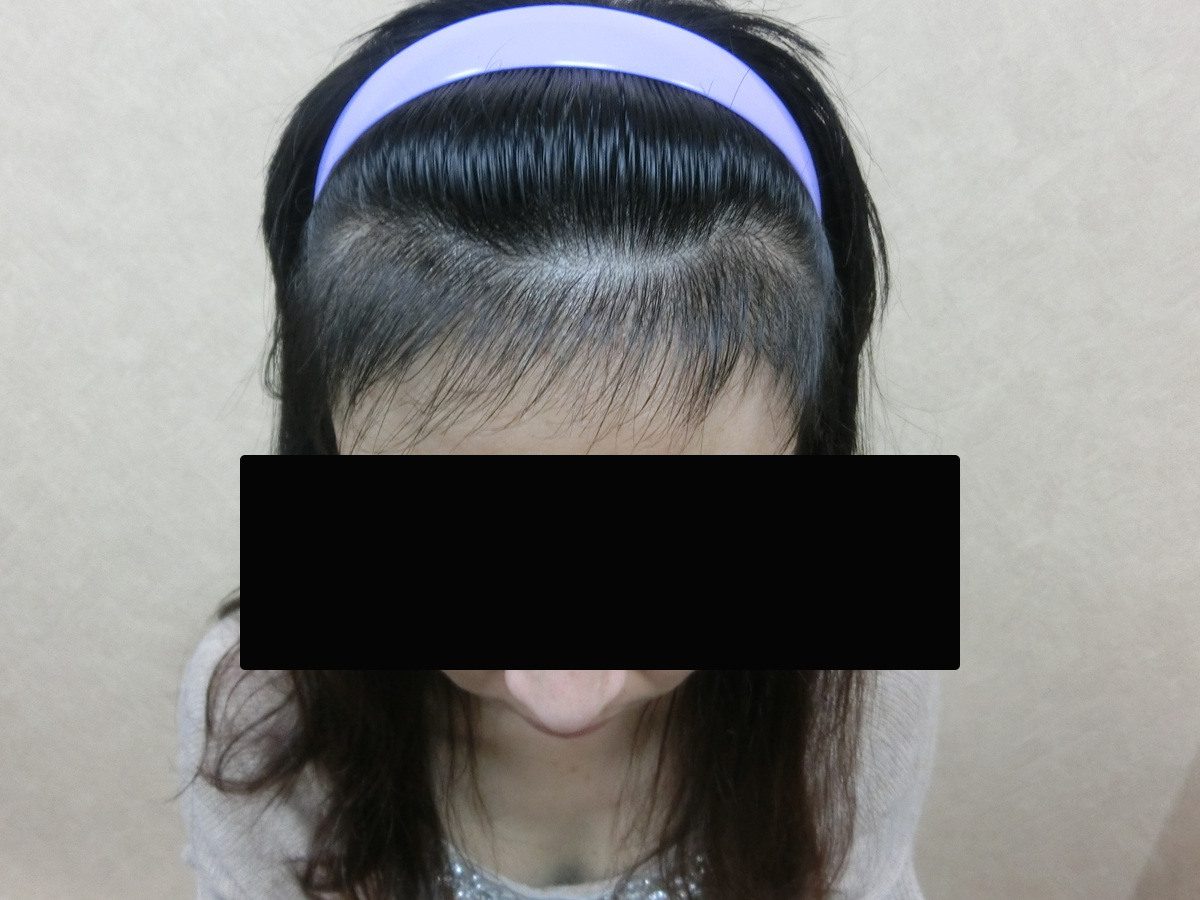 女性高髮際線正面俯視療程前與後續影像:植髮後