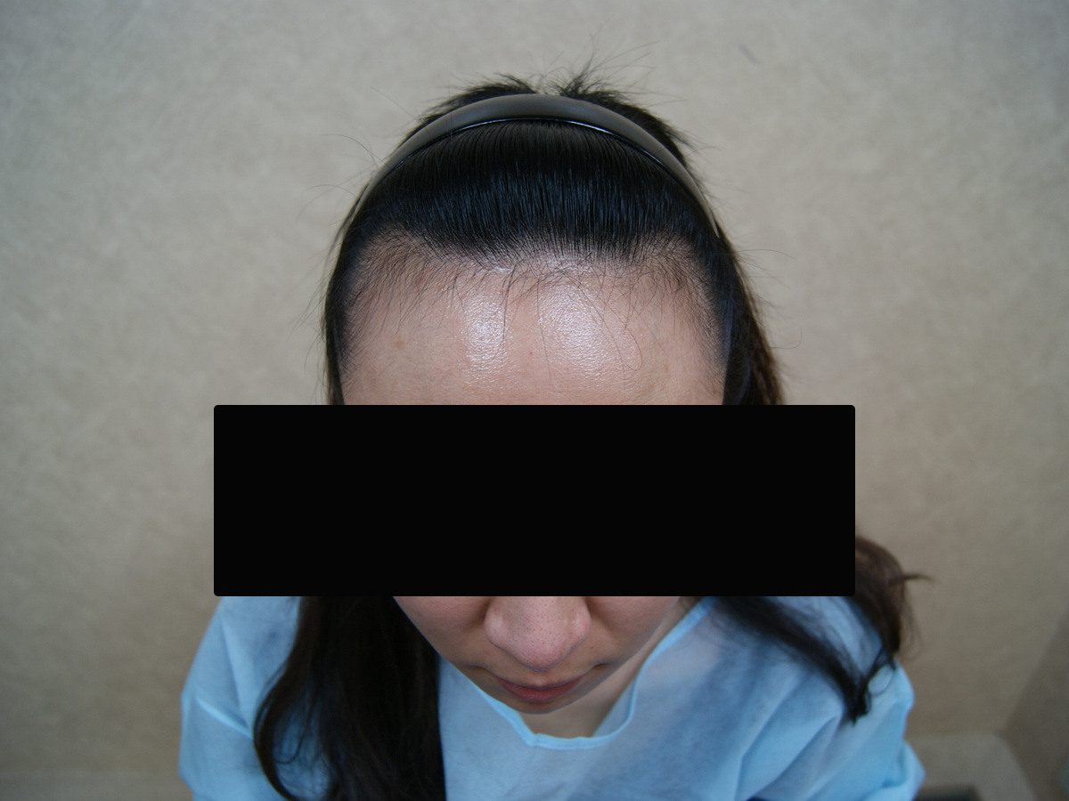 女性高髮際線正面俯視療程前與後續影像:植髮前