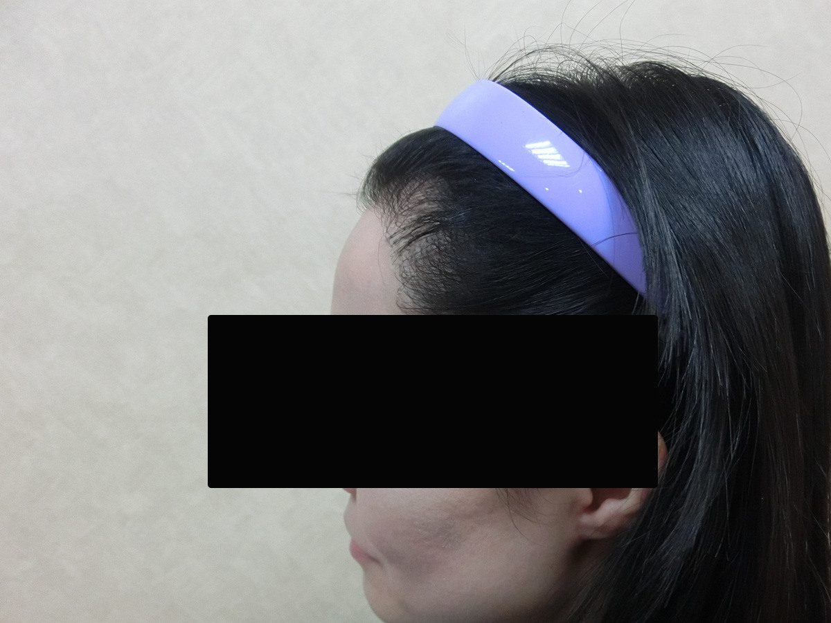 女性高髮際線右側額角療程前與後續影像:植髮後