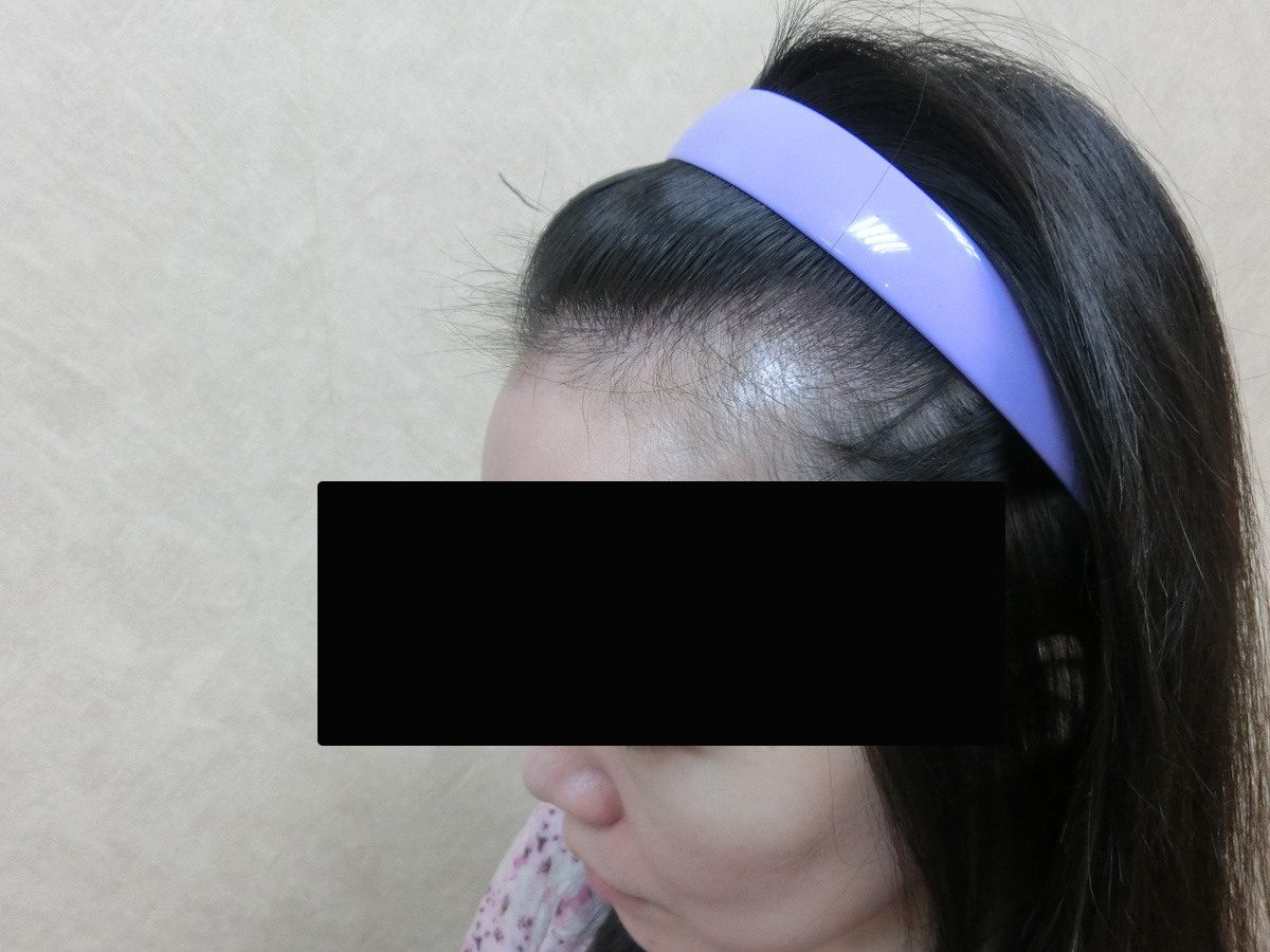 女性高髮際線右側額角療程前與後續影像:植髮前