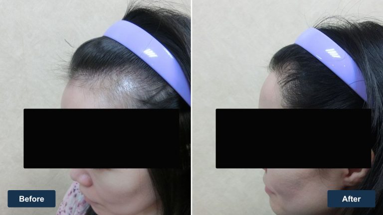 女性右側額角植髮案例｜側邊髮流與轉折紀錄