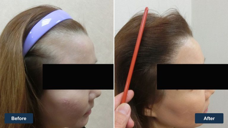 約 40 多歲台灣女性高髮際線左側額角前後影像比較