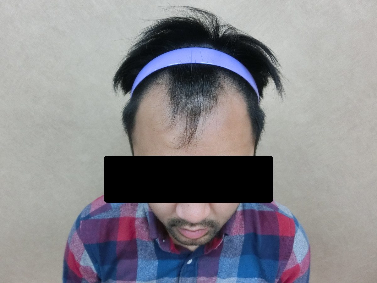 FUE 1523 株正面髮際線療程前與約 7 個月追蹤:植髮前
