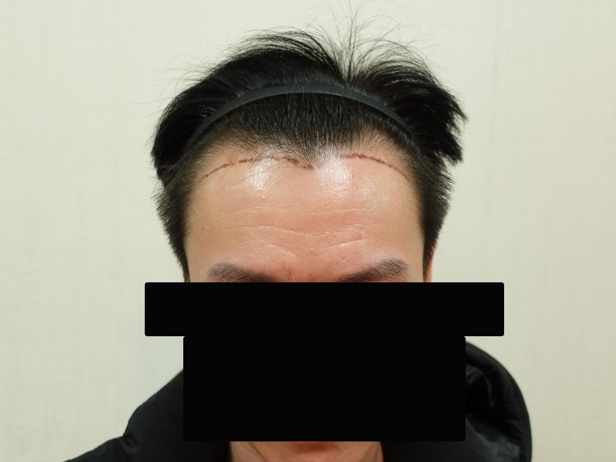 FUE 1200 株正面髮際線案例:植髮前