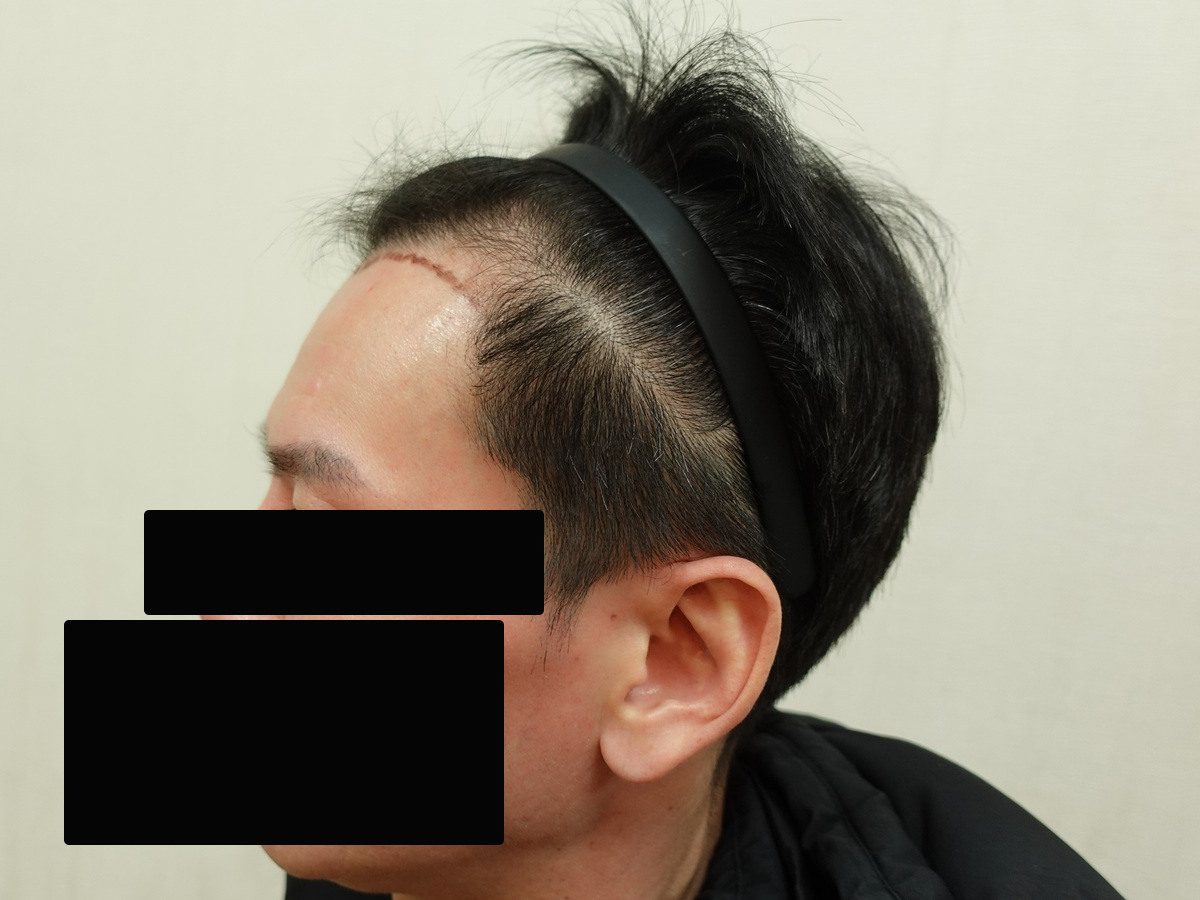 FUE 1200 株左側額角案例:植髮前