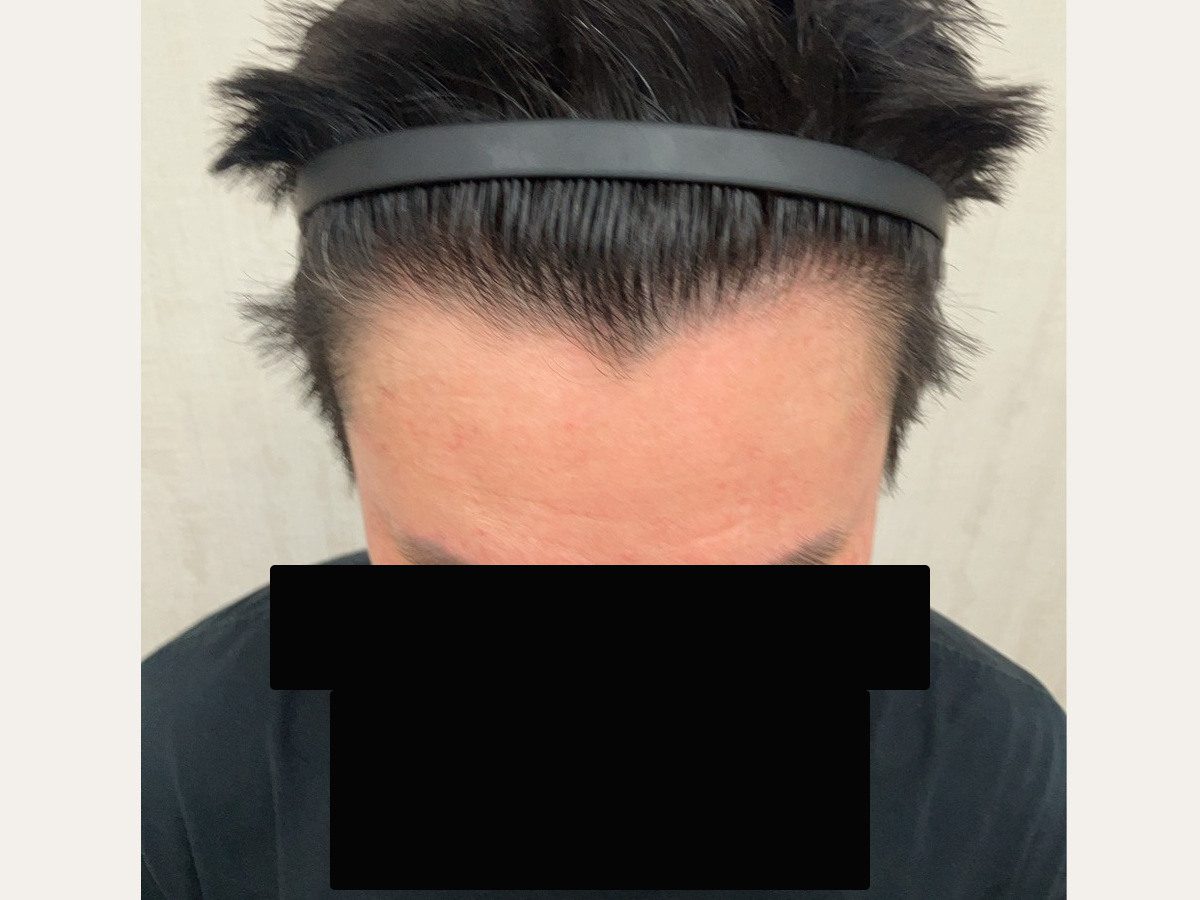FUE 1200 株前額俯視案例:植髮後