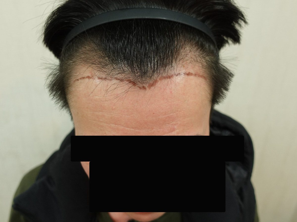 FUE 1200 株前額俯視案例:植髮前