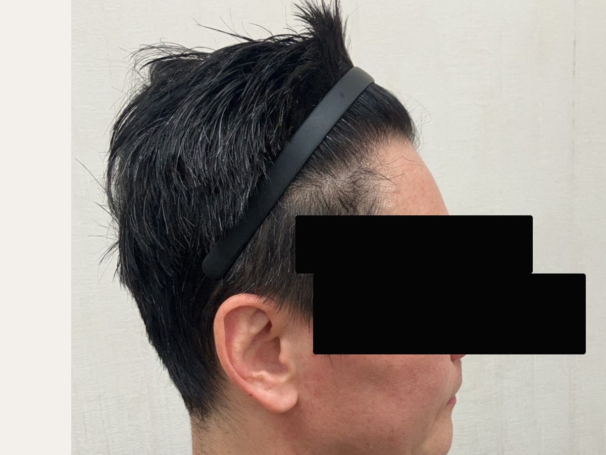 FUE 1200 株右側額角案例:植髮後