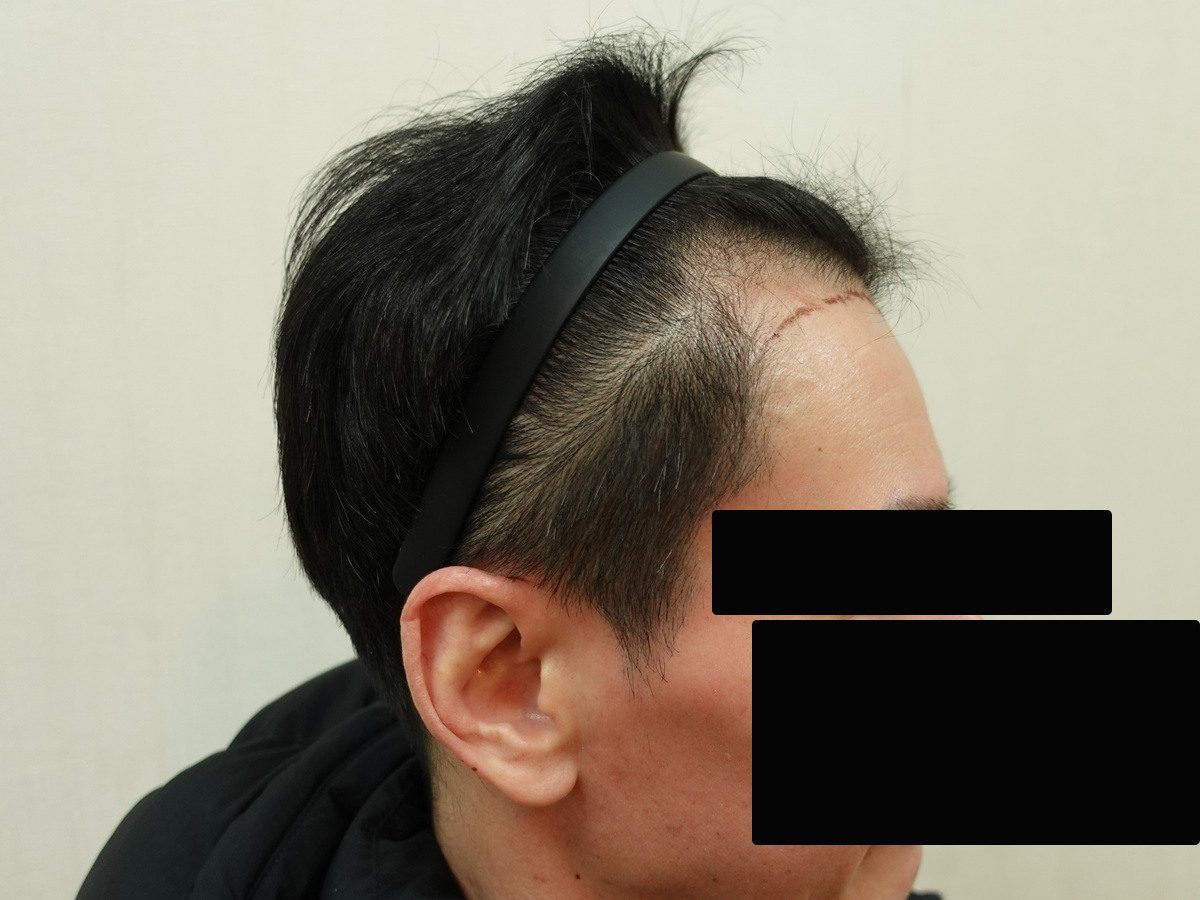 FUE 1200 株右側額角案例:植髮前