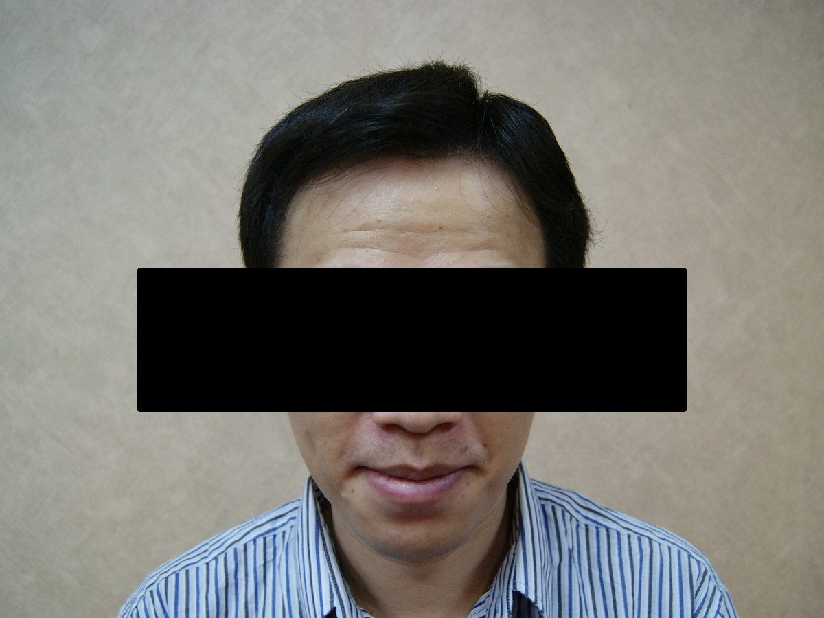 FUE 1632 株正面髮際線療程前與後續影像，術後