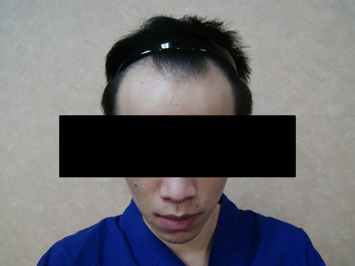 FUE 1632 株正面髮際線療程前與後續影像,術前
