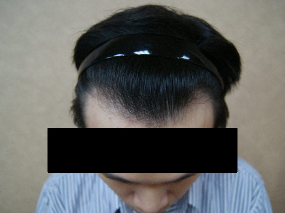 FUE 1632 株上方前額療程前與後續影像，術後
