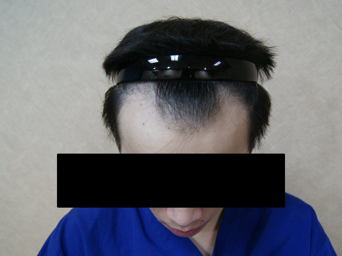 FUE 1632 株上方前額療程前與後續影像,術前