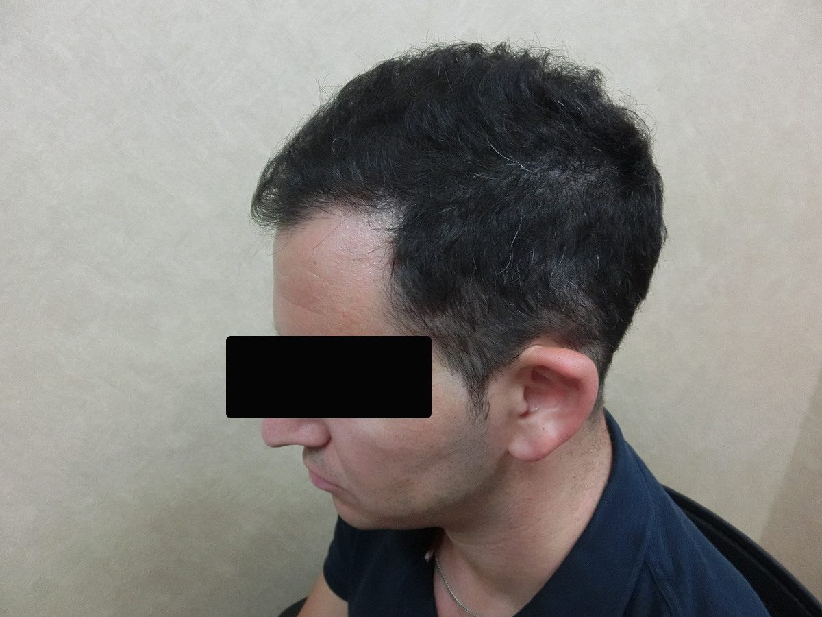 FUE 2900 株左側額角療程前與後續影像:植髮後