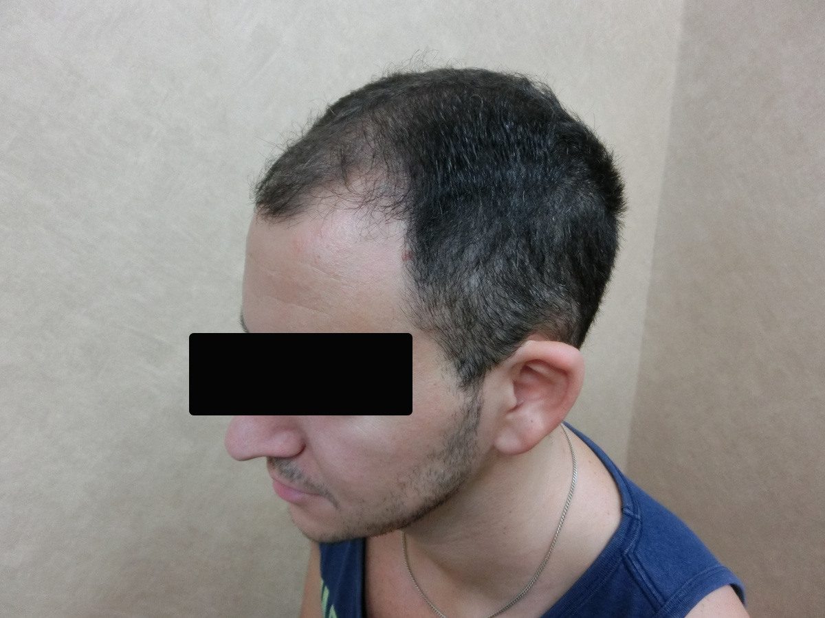 FUE 2900 株左側額角療程前與後續影像:植髮前