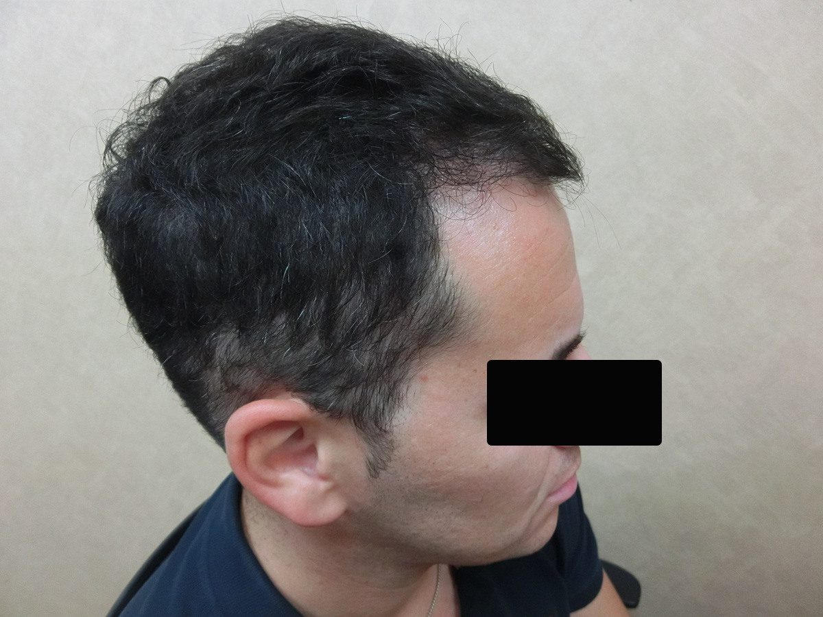 FUE 2900 株右側額角療程前與後續影像:植髮後