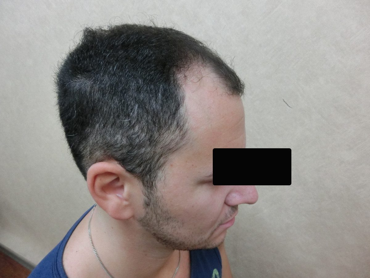 FUE 2900 株右側額角療程前與後續影像:植髮前