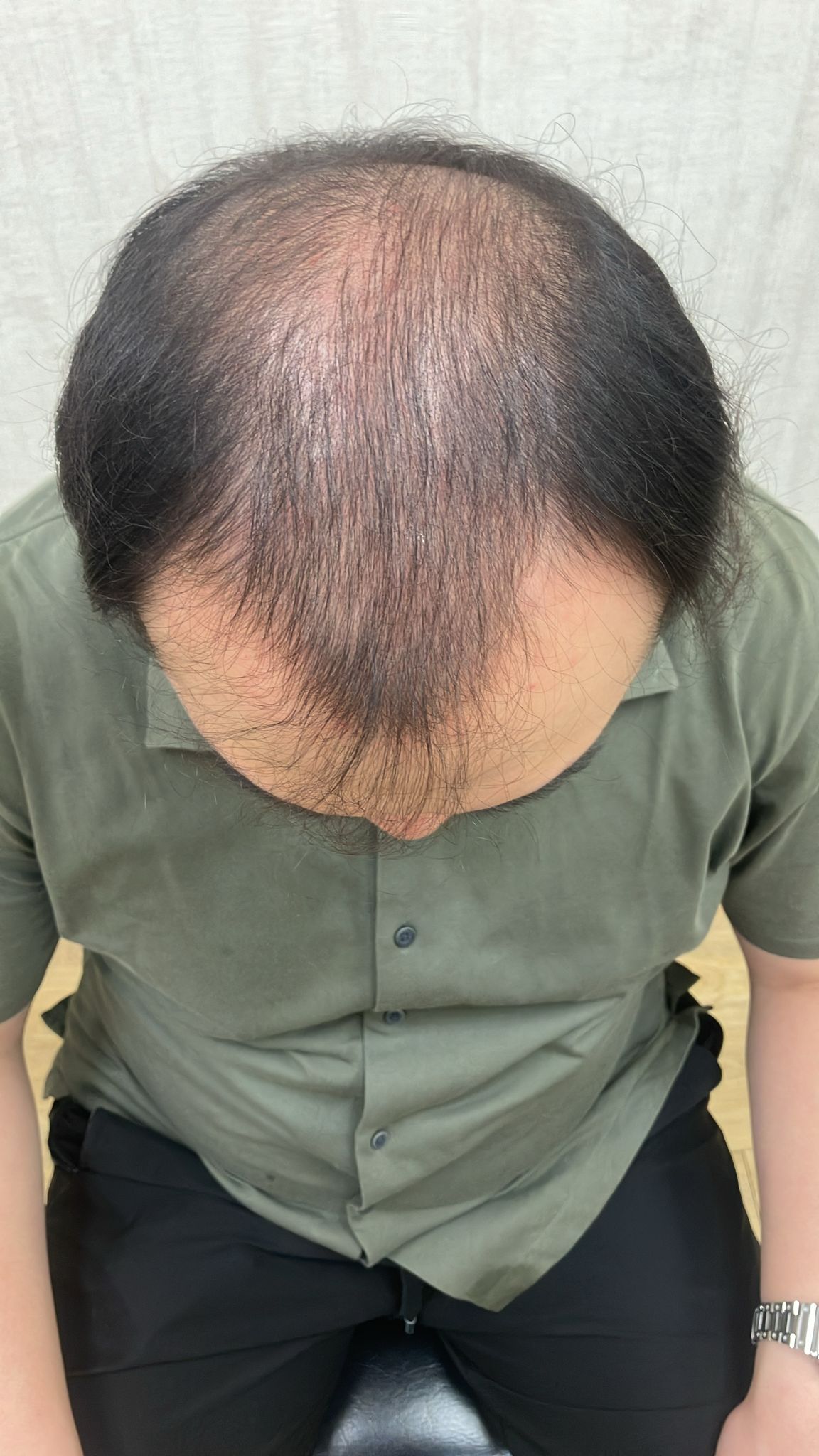 FUE 3000 株前額至頭頂案例:植髮前