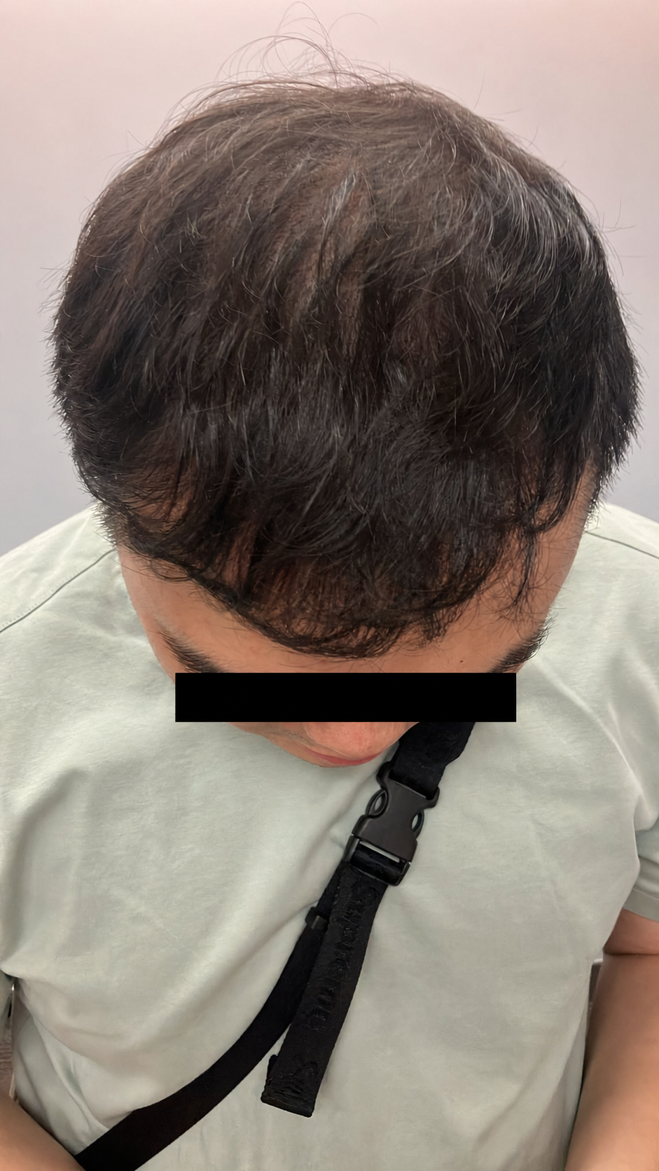 FUE 3000 株前額至頭頂案例:植髮後