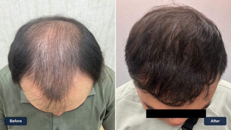 FUE 3000 株植髮案例橫式前後影像比較