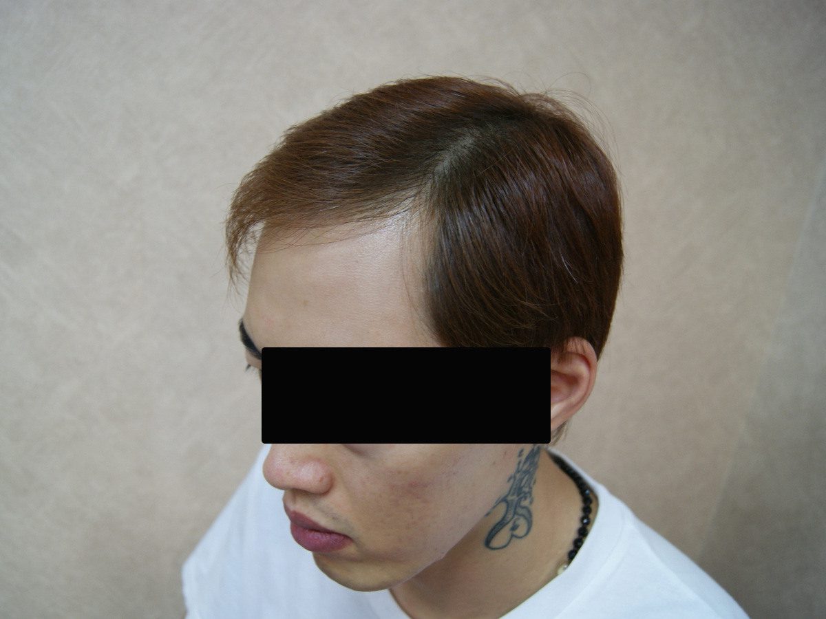 FUE 3013 株左側前額與額角術前術後案例:植髮後