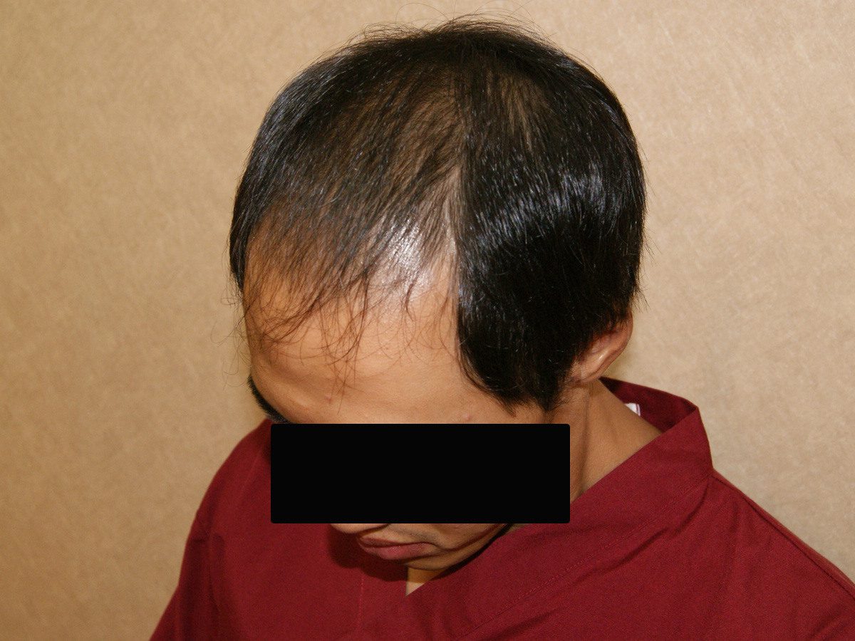 FUE 3013 株左側前額與額角術前術後案例:植髮前