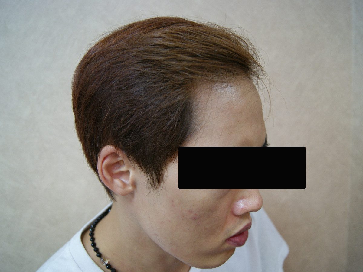 FUE 3013 株右側前額與額角術前術後案例:植髮後