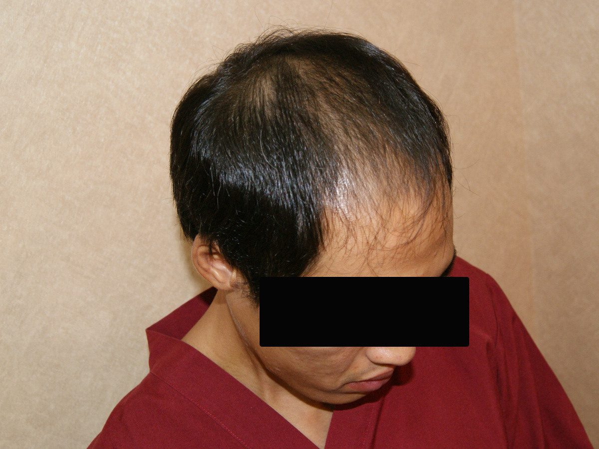 FUE 3013 株右側前額與額角術前術後案例:植髮前