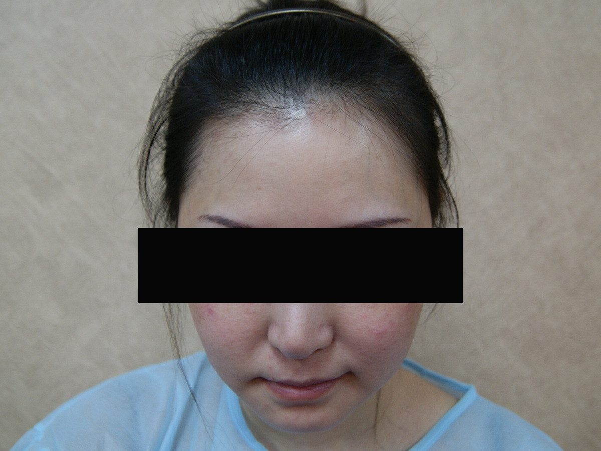 FUT 2051 株女性髮際線植髮案例正面比較:植髮前