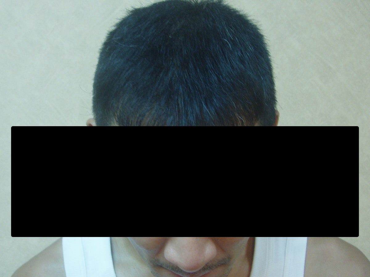 FUT 3254 株正面髮際線療程前與後續影像:植髮後