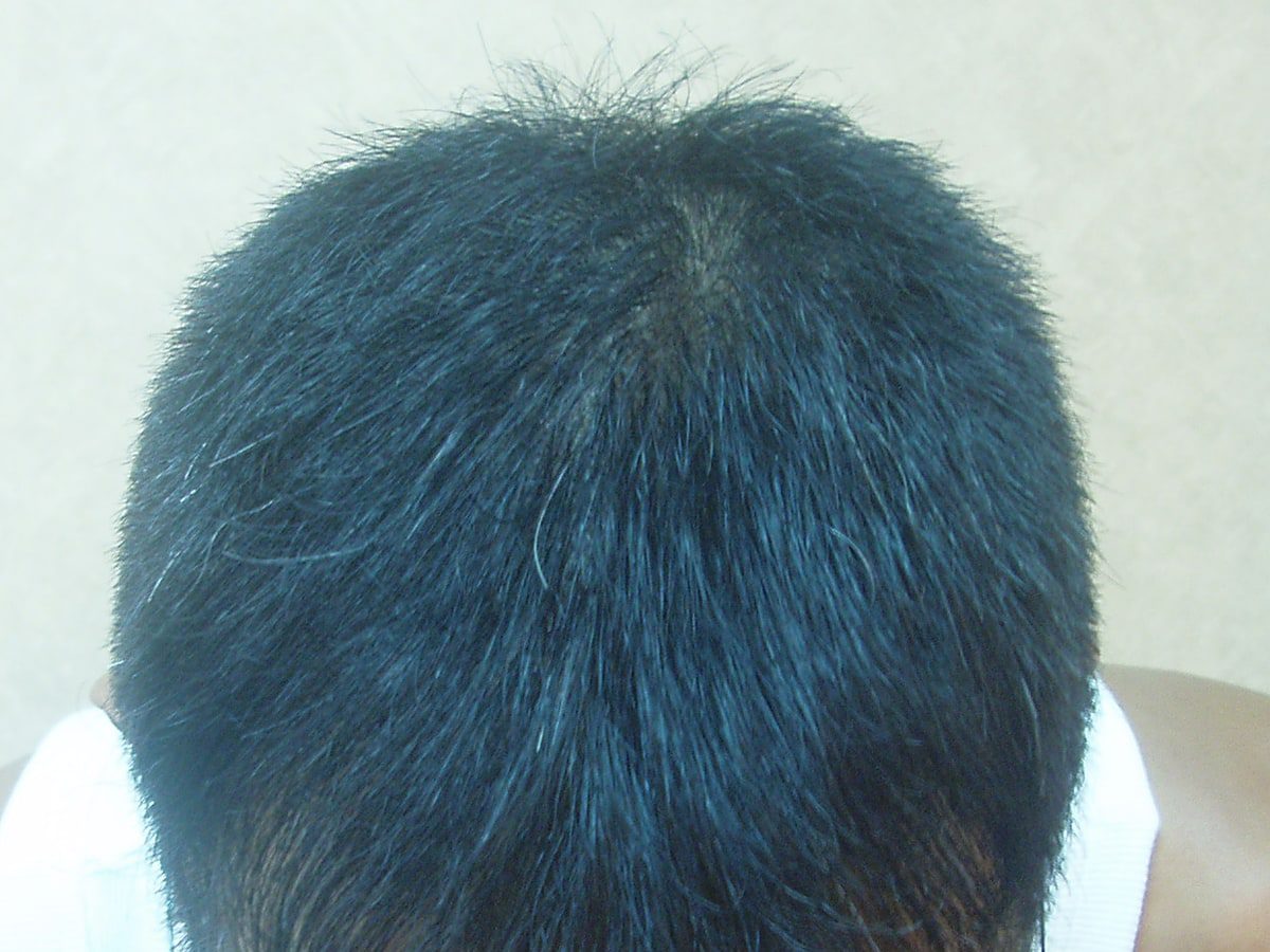 FUT 3254 株前額至頭頂療程前與後續影像:植髮後