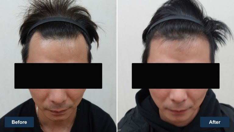 澳門 40 歲男性髮際線植髮案例｜雙角度影像紀錄