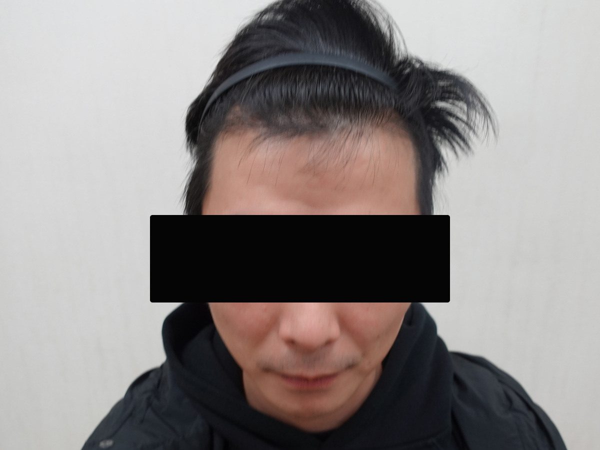 澳門 40 歲男性正面髮際線療程前與後續影像:植髮後