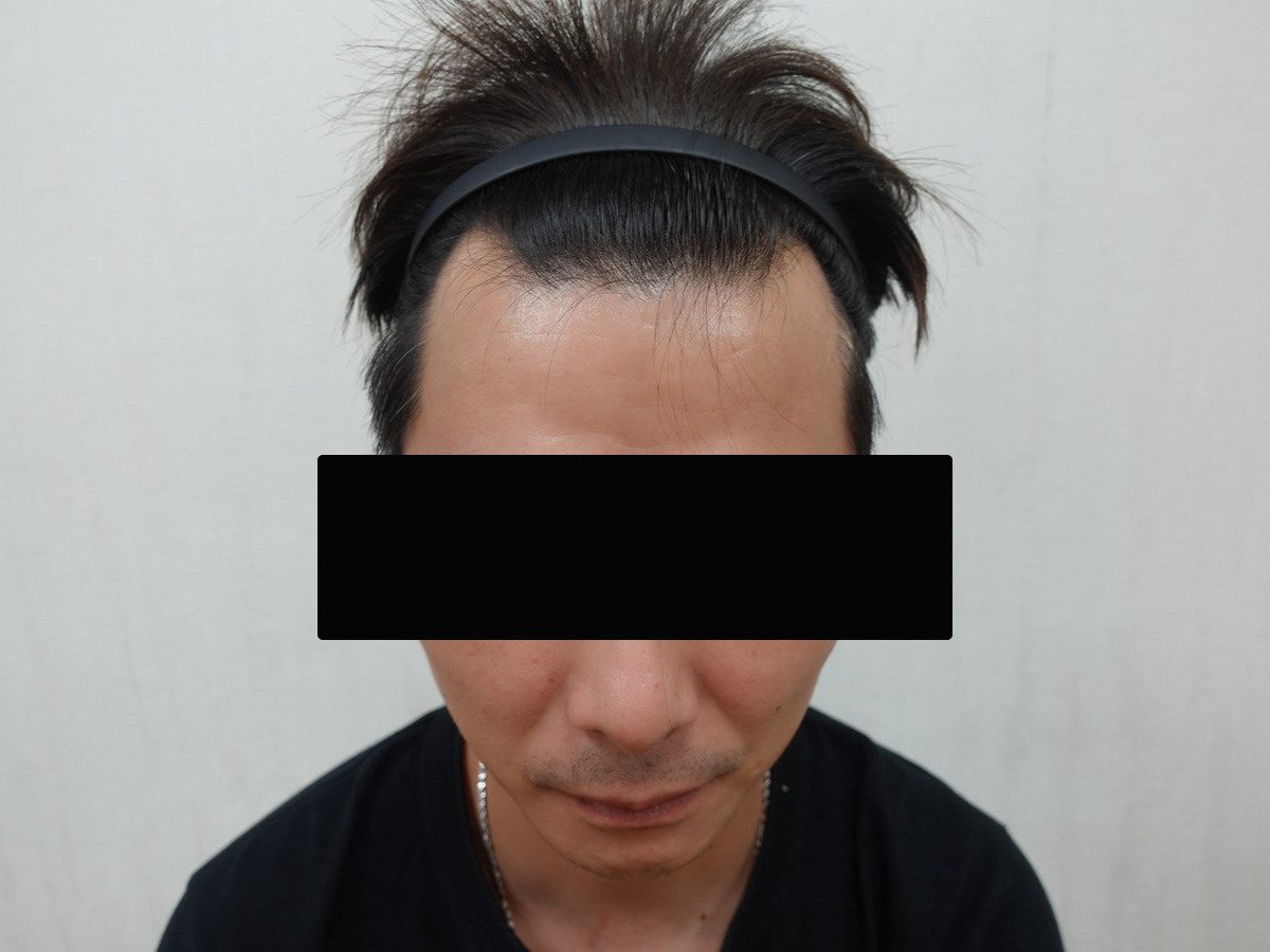澳門 40 歲男性正面髮際線療程前與後續影像:植髮前